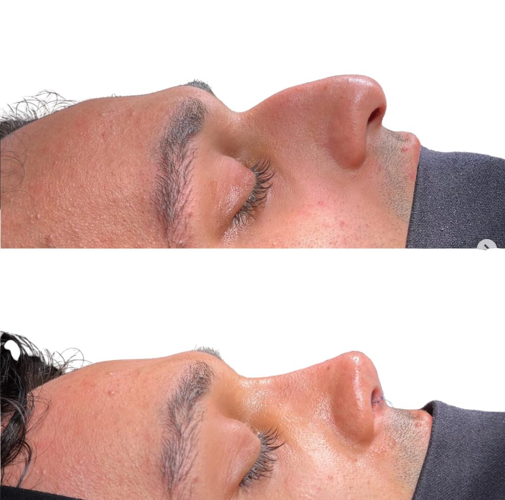 Rhinoplasty before and after, male patient top and bottom profile
