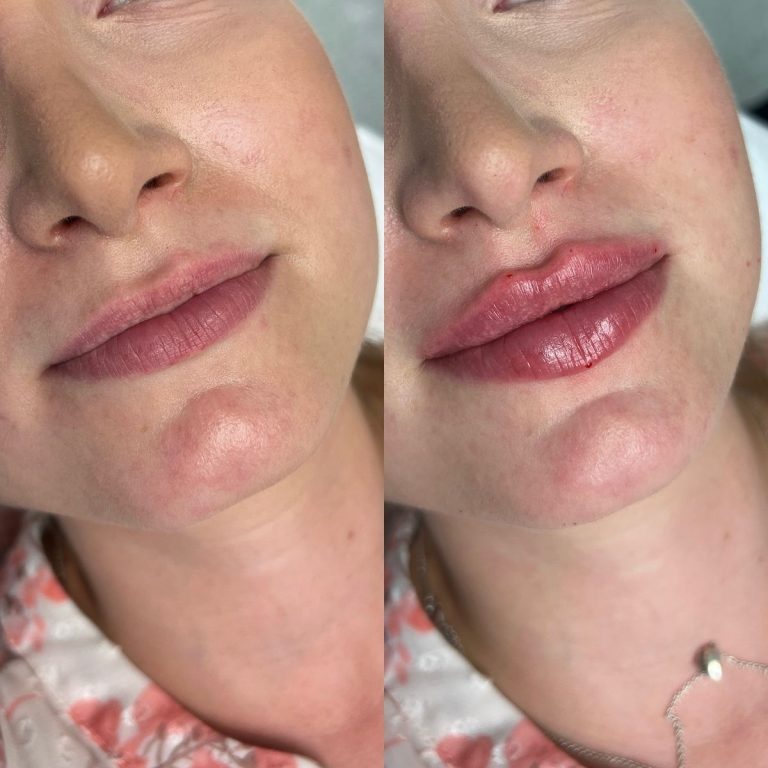 botox and dermal fillers before and after result Islamabad patient 4