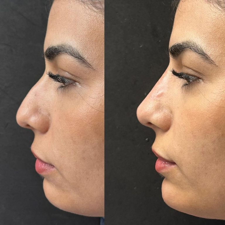 rhinoplasty before and after result Islamabad patient 4