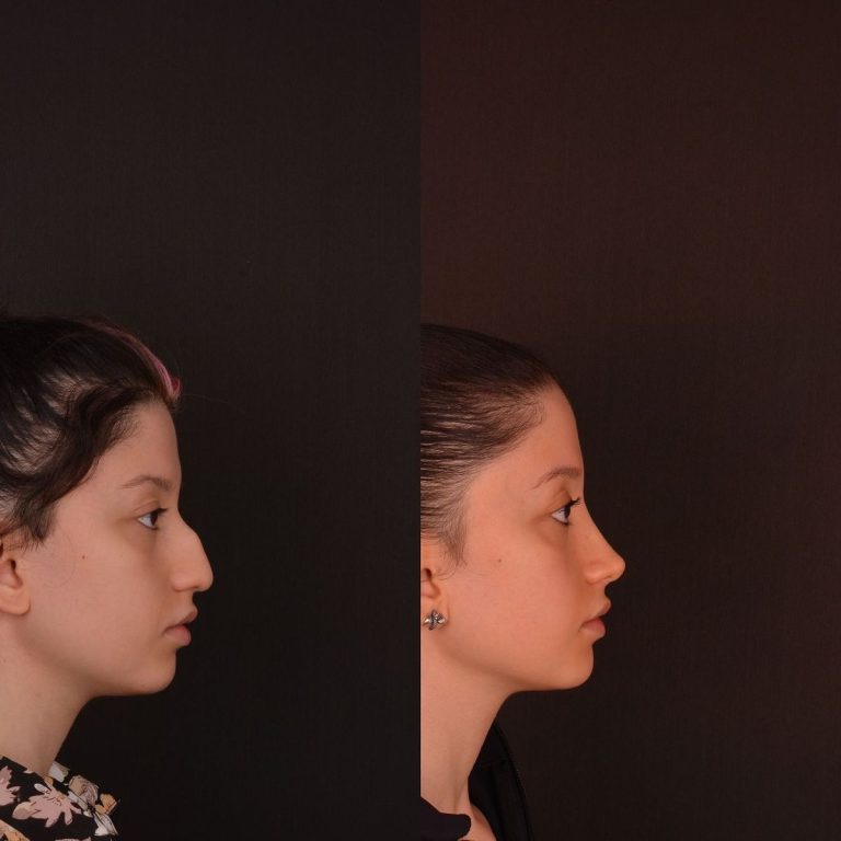 rhinoplasty before and after result Islamabad patient 5