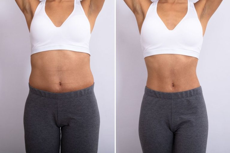 Illustrative fat reduction before and after, abdomen front view