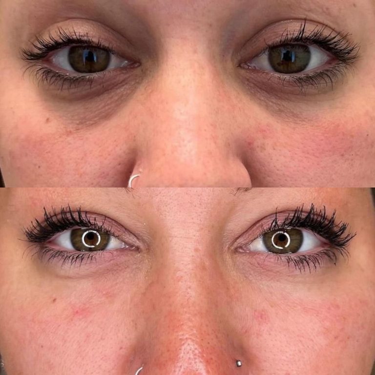 blepharoplasty before and after result Islamabad patient 2