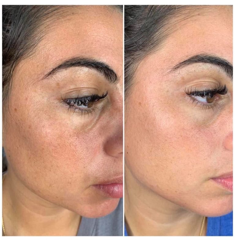 botox and dermal fillers before and after result Islamabad patient 6