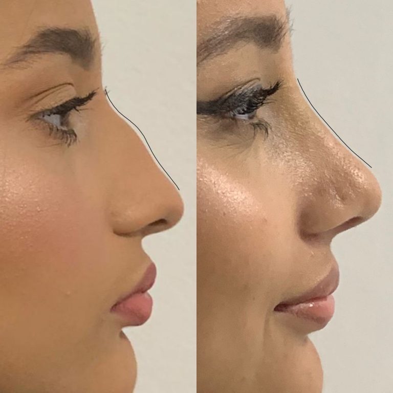 rhinoplasty before and after result Islamabad patient 3