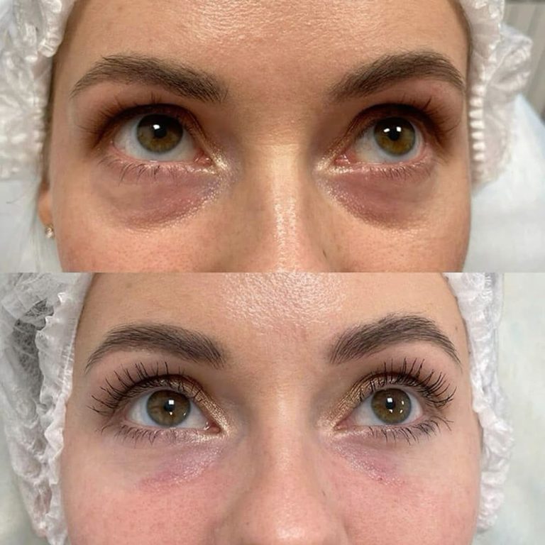 blepharoplasty before and after result Islamabad patient 4