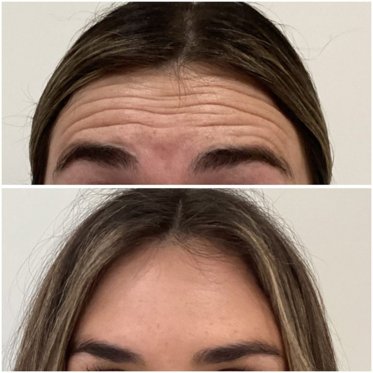 botox and dermal fillers before and after result Islamabad patient 3