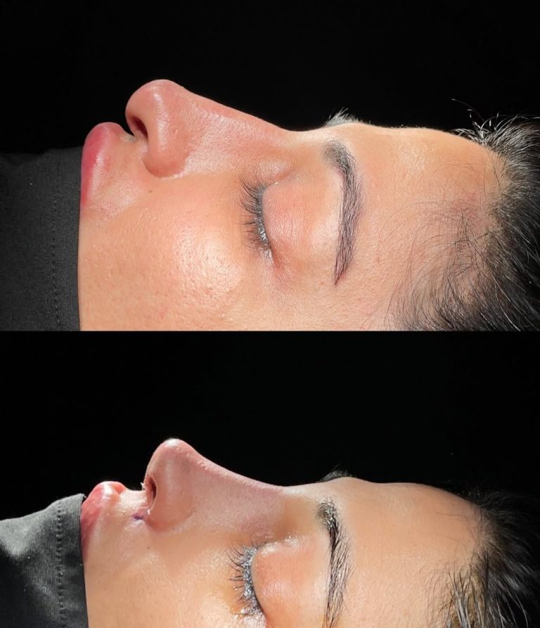 rhinoplasty before and after result Islamabad patient 2