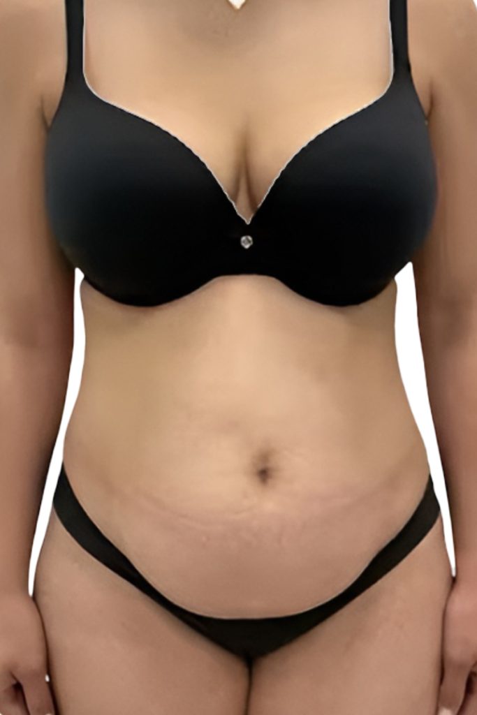 Breast augmentation result, before photo