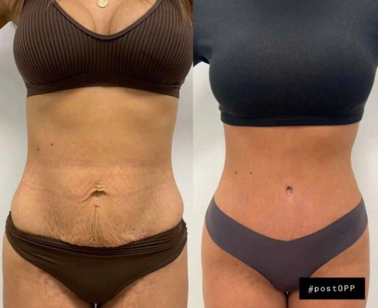 Tummy tuck before and after, abdomen