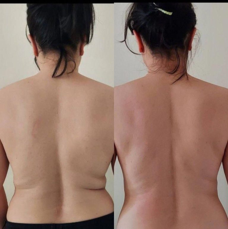 Liposuction before and after, back and flanks