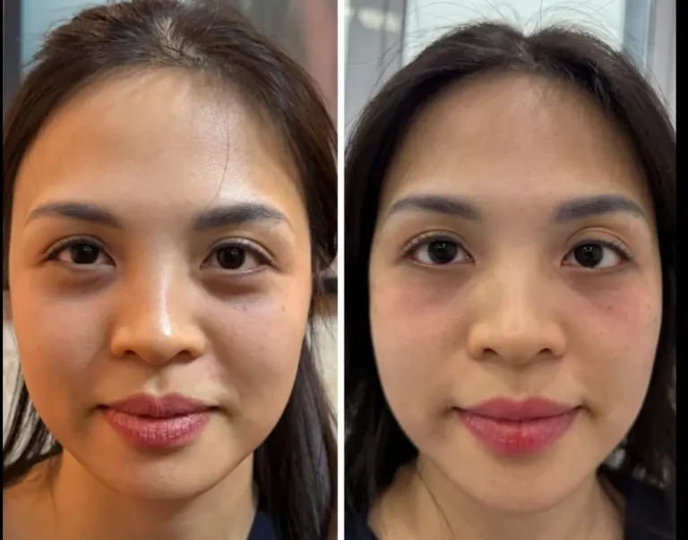 Facial skin treatment before and after