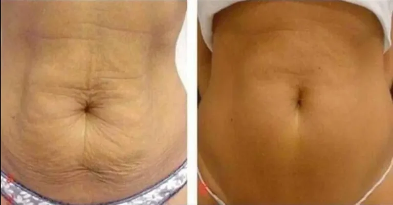 Tummy tuck before and after, abdomen