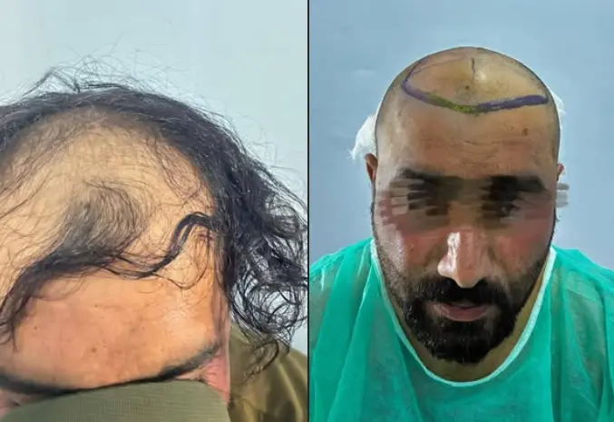 Hair transplant before and after, hairline