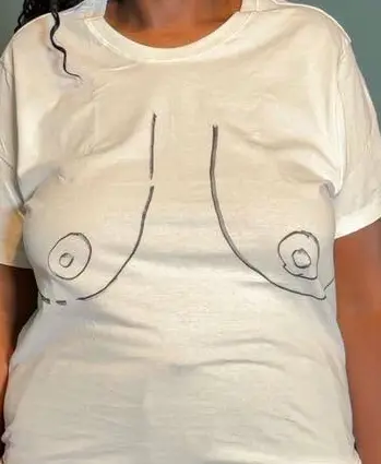 Breast reduction surgical markings