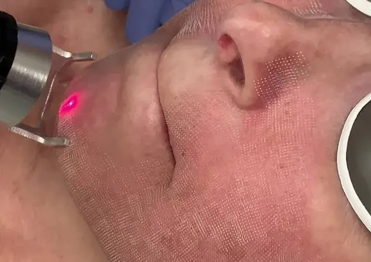 Laser skin treatment being performed on the face