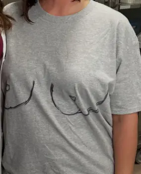 Breast lift surgical markings