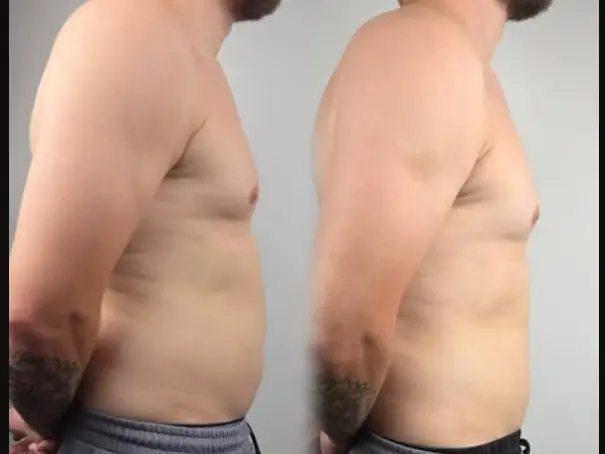 Gynecomastia surgery before and after, side view