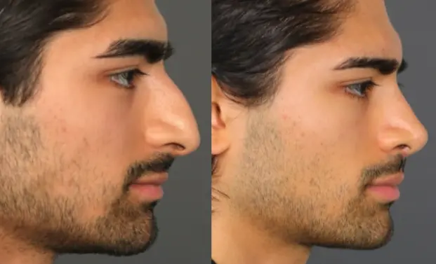Rhinoplasty before and after, male side profile