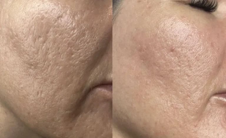 Acne scar treatment before and after, cheek