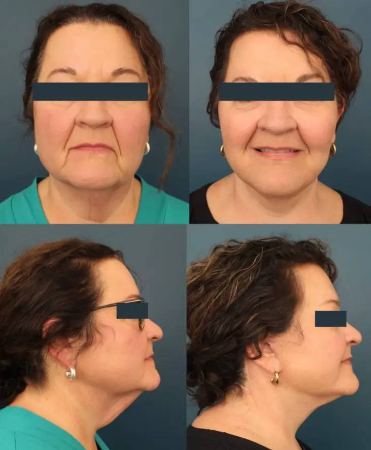 Facelift before and after, front and side views