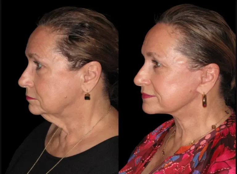 Facelift and neck lift before and after, side profile
