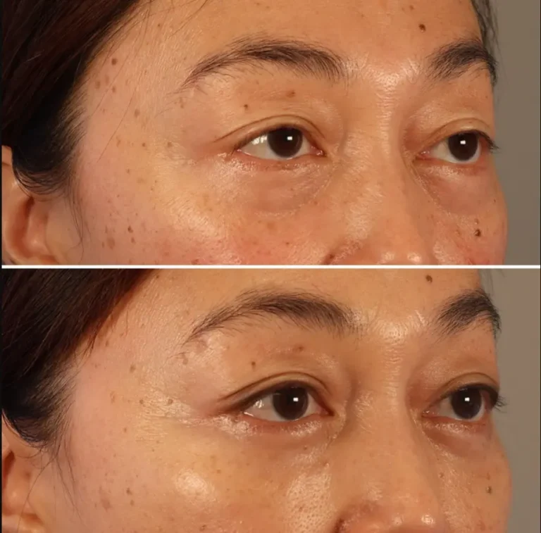 Upper blepharoplasty before and after