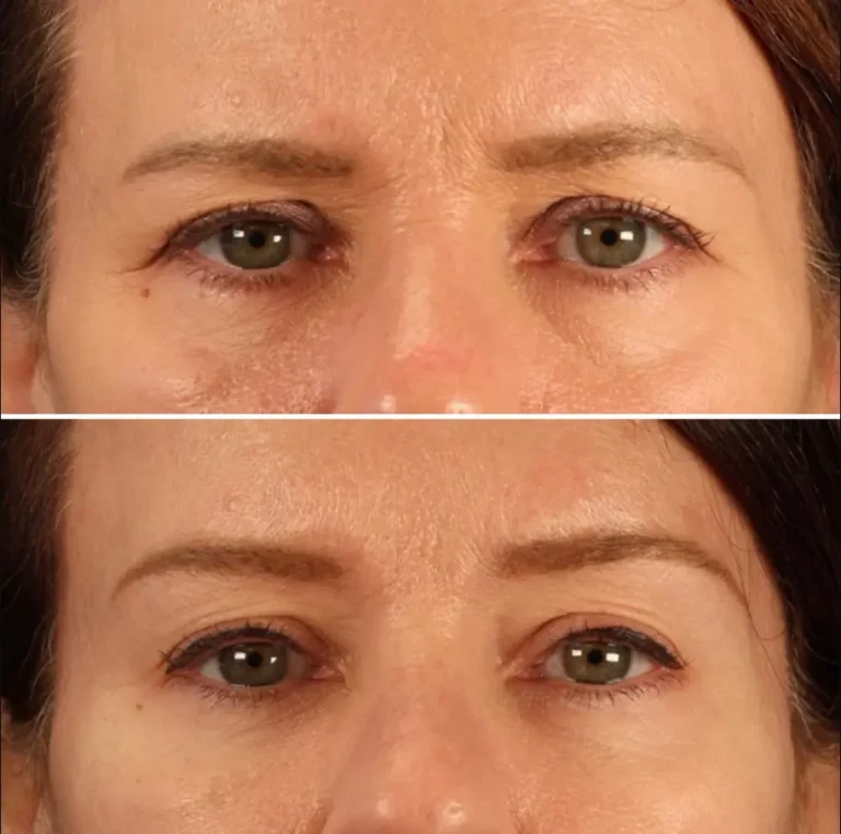Brow lift before and after, raised brows and open eyes