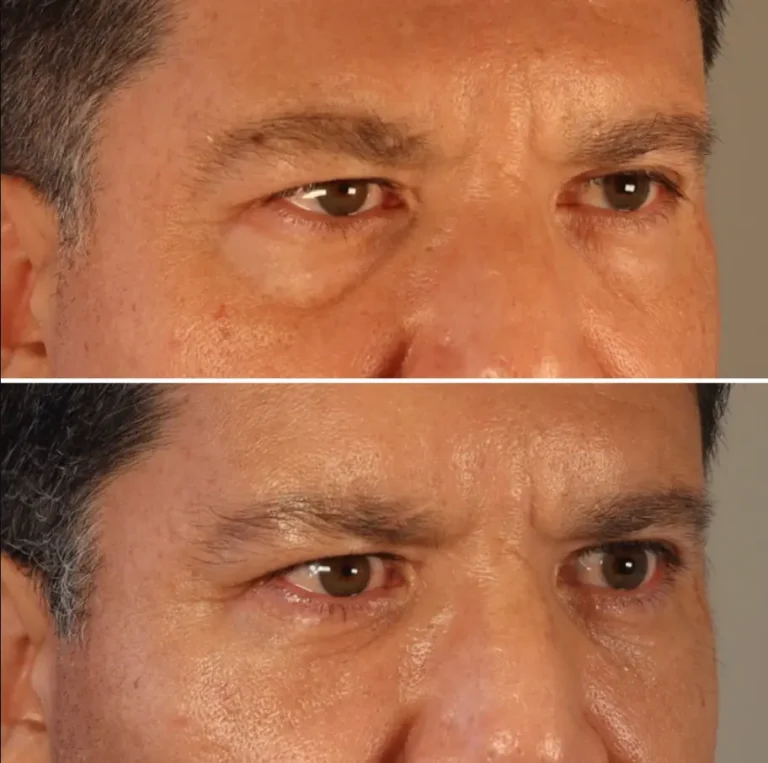 Brow lift before and after, male patient