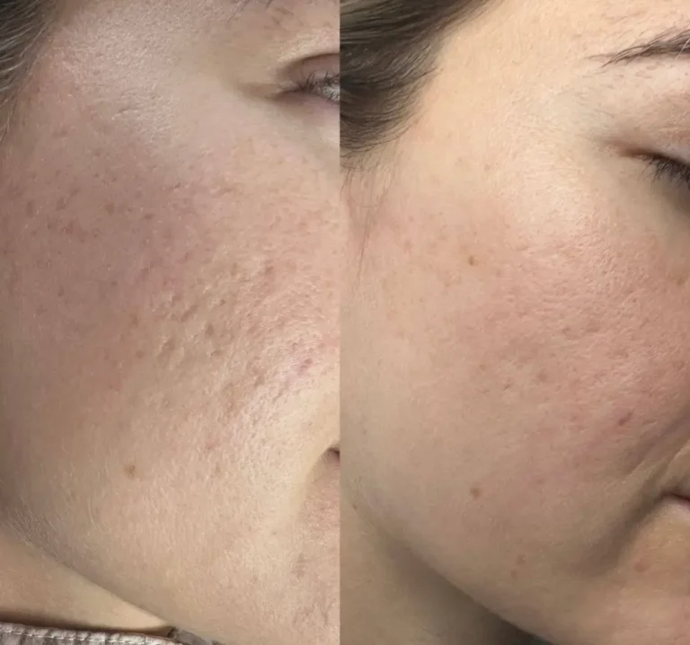 Acne scar and skin texture treatment before and after