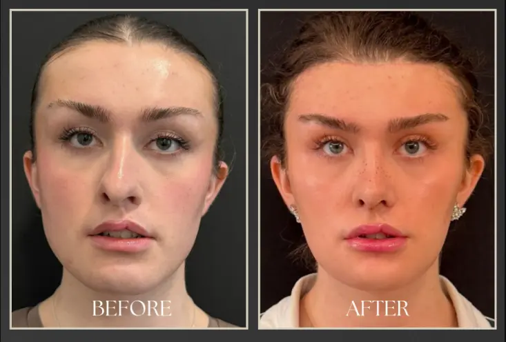 Brow lift before and after, front view