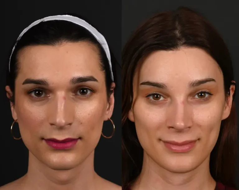 Facial contouring before and after, front view