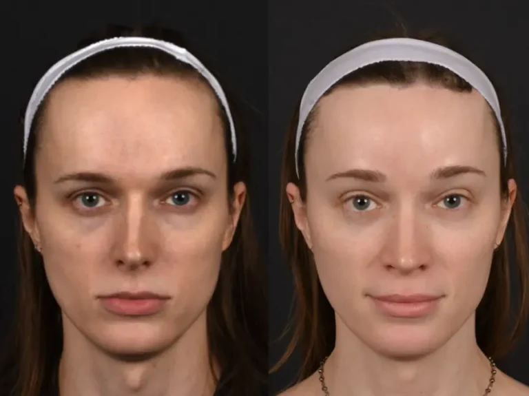 Brow lift before and after, front view