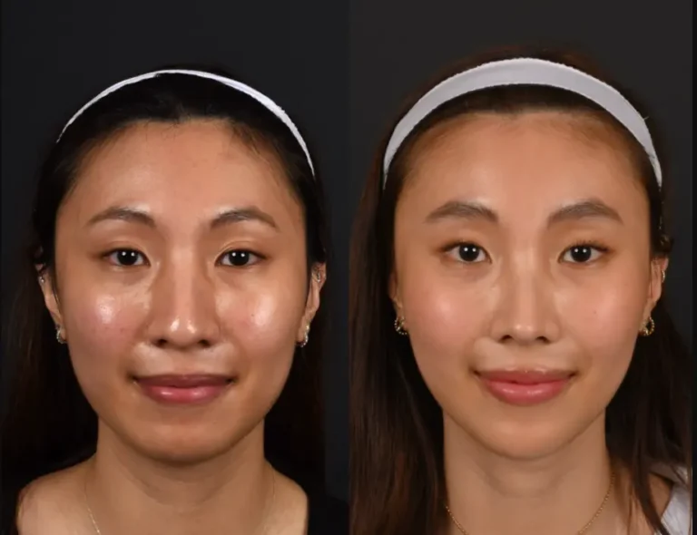 Brow lift before and after, front view, female patient