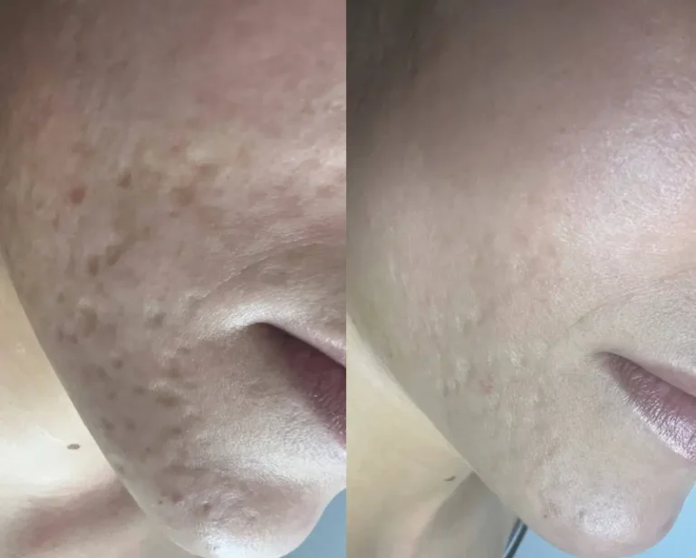 Acne scar treatment before and after, nose and cheek