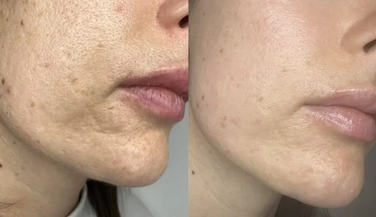 Pigmentation treatment before and after, cheek