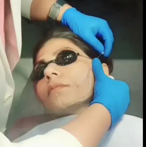 Laser treatment session with protective eye shields