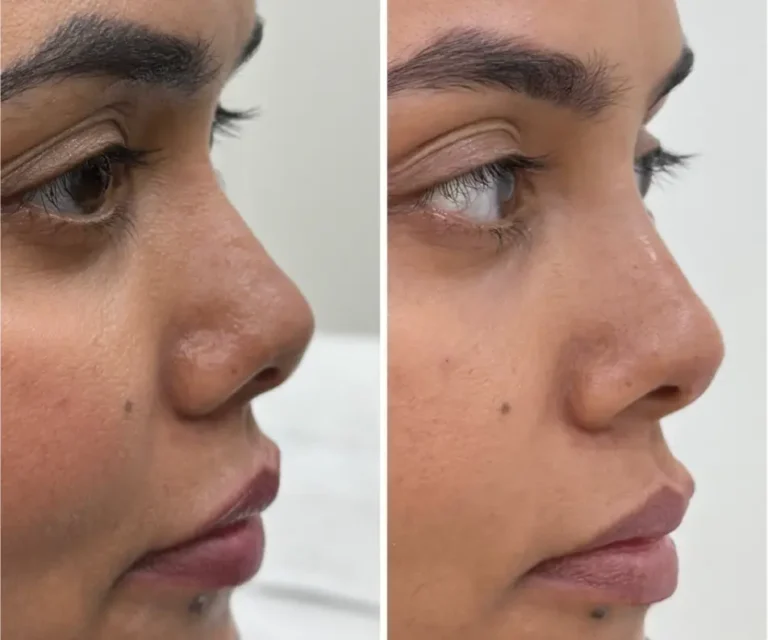 Rhinoplasty before and after, side profile