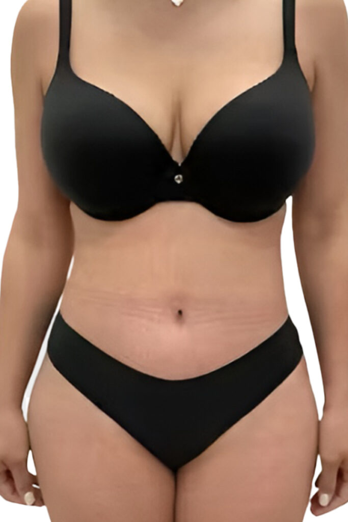 Breast augmentation result, after photo