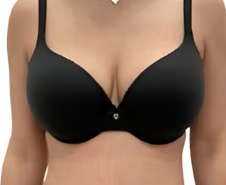 Breast augmentation result, after photo