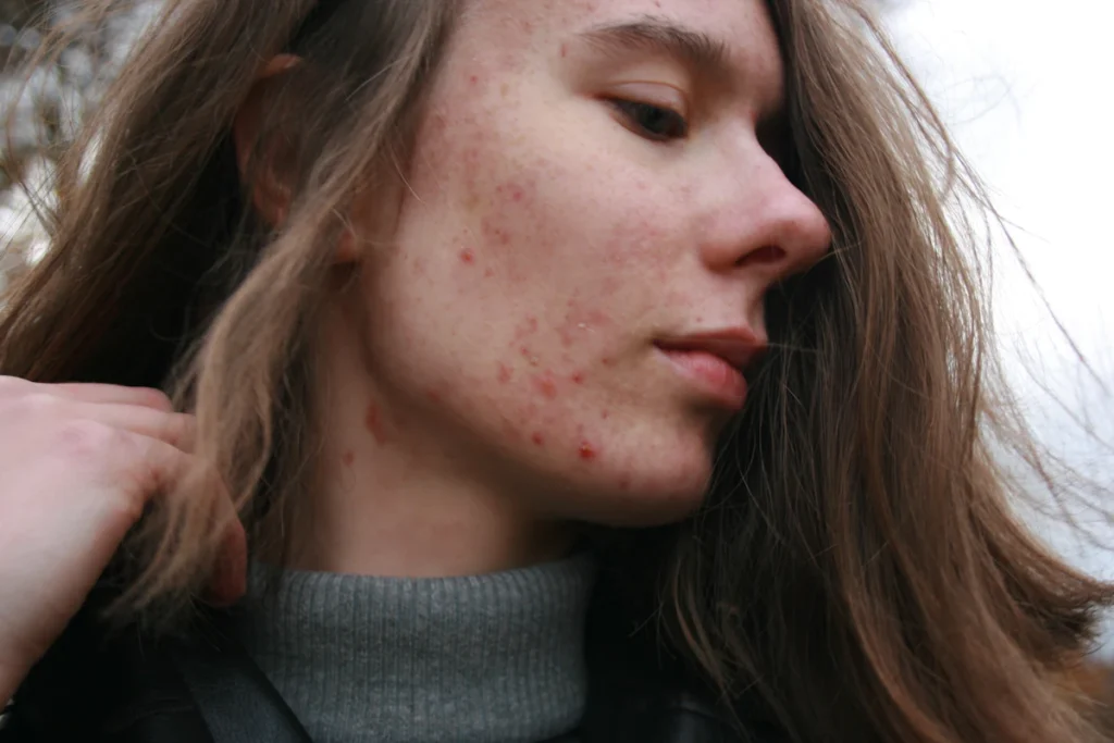 Acne and marks on the cheek, acne scar treatment in Islamabad