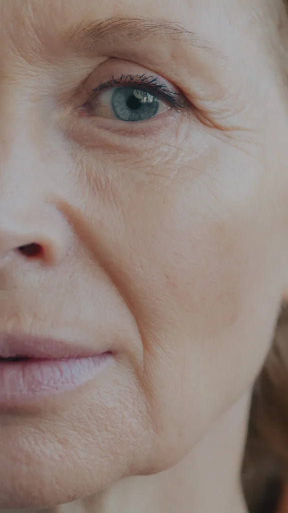 Fine lines on mature skin, anti-aging treatment in Islamabad