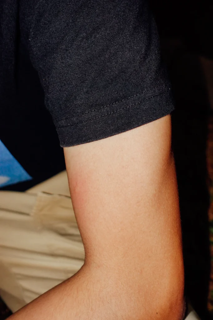 Upper arm skin and shape, brachioplasty