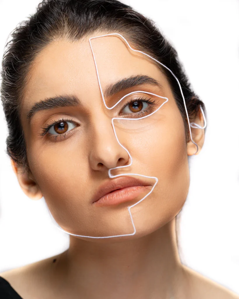 Facial lines over the cheeks, buccal fat removal approach