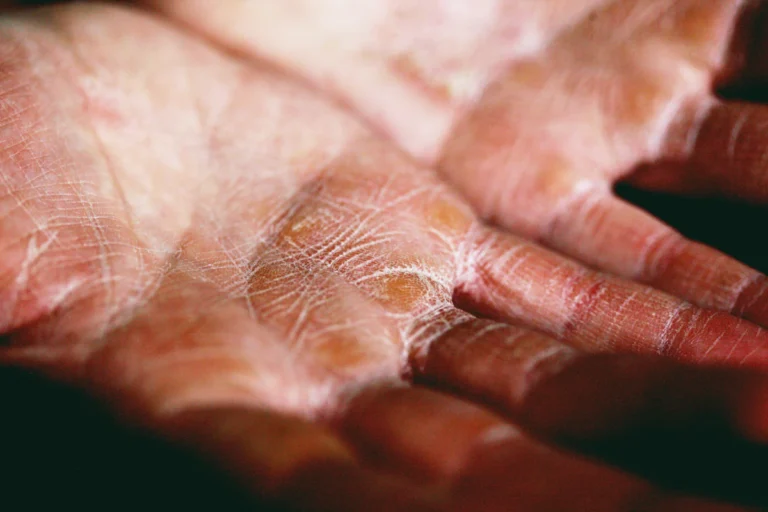 Healing skin on the hand