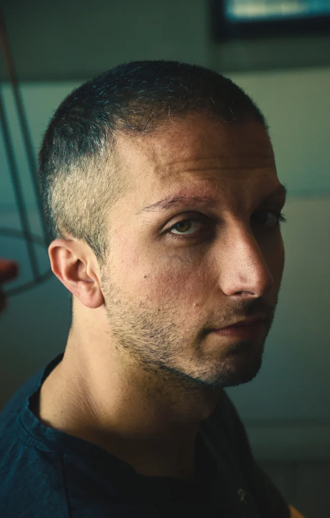 Man with a receding hairline considering DHI