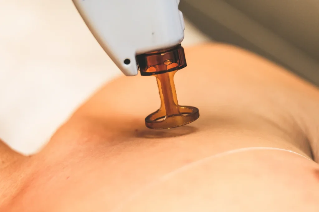 Fat freezing applicator on the skin, cryolipolysis treatment