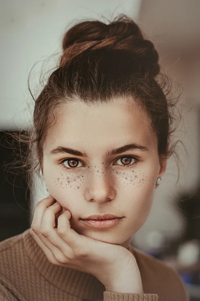 Freckles across the nose and cheeks, freckle removal in Islamabad