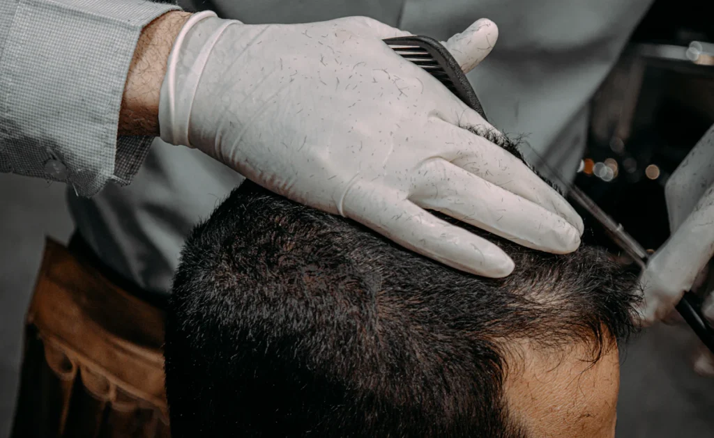 Gloved hand checking the scalp, FUE hair transplant in Islamabad