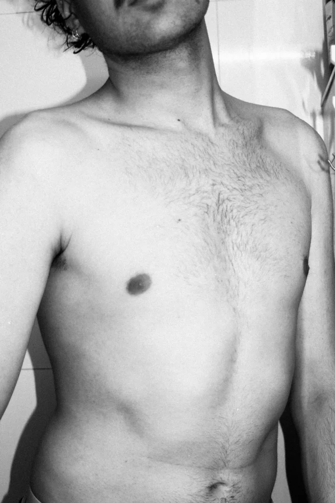 Male chest, gynecomastia surgery in Islamabad