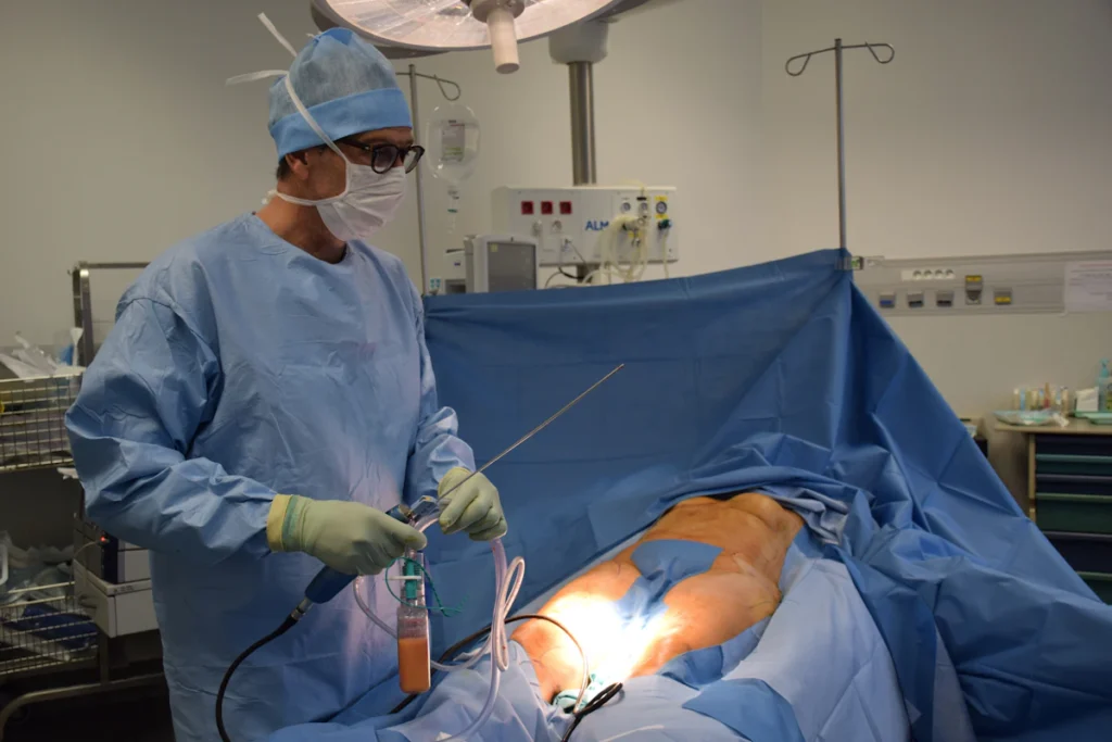 Laser liposuction cannula in use, laser liposuction in Islamabad